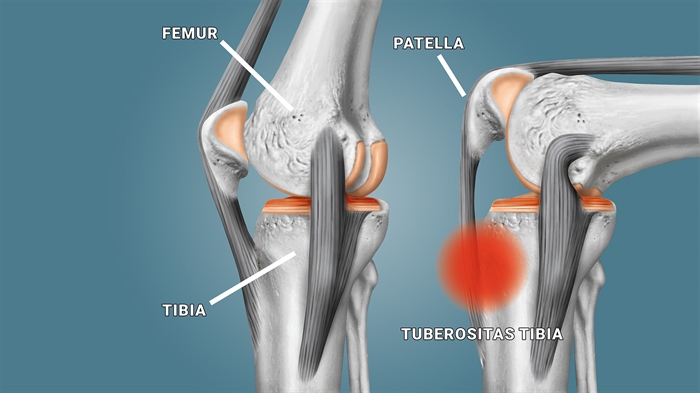 Osgood Schlatter